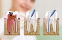 Endodoncia