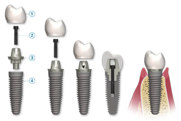 Partes de un implante dental de titanio con funda.