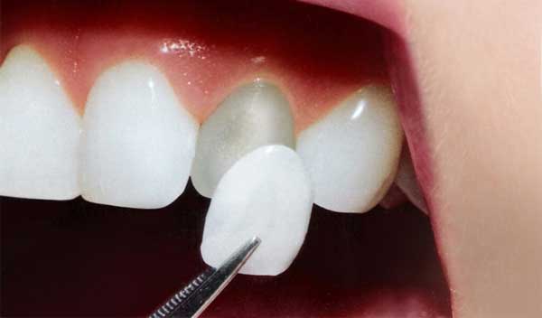 Carilla dental (funda solo para la parte de delante del diente).