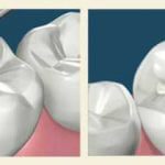 Empaste dental de composite.