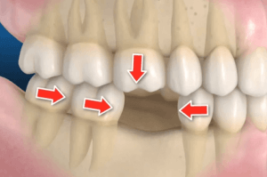 desplazamiento dental perdida