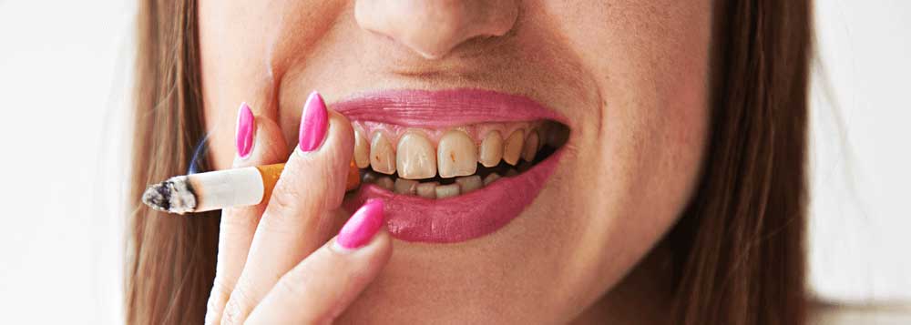 Boca con dientes con manchas típicas del tabaco.