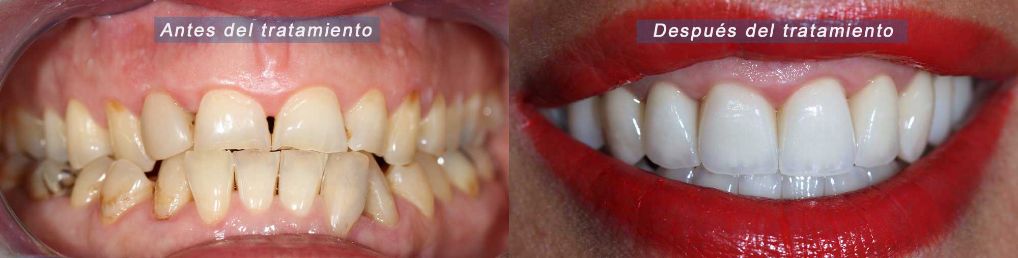 Antes y después de una paciente con rehabilitación completa con coronas dentales por desgaste severo.
