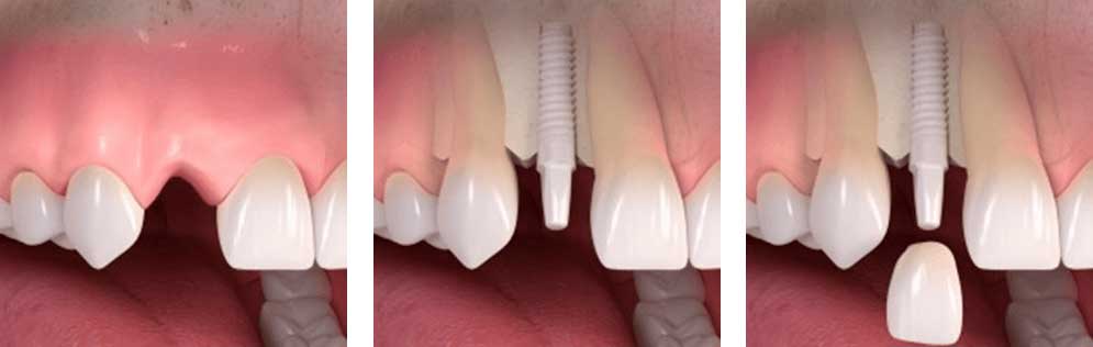 Implante dental de zirconio y corona (funda) sobre implante