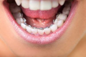 Ortodoncia lingual: brackets colocados por detras de los dientes.