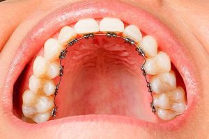 Ortodoncia lingual (brackets por detrás de los dientes).