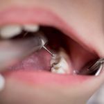 Limpieza de la caries niño.