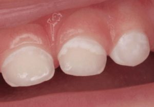 Mancha blanca caries niños