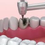 Limpieza de la caries, primera parte del tratamiento.