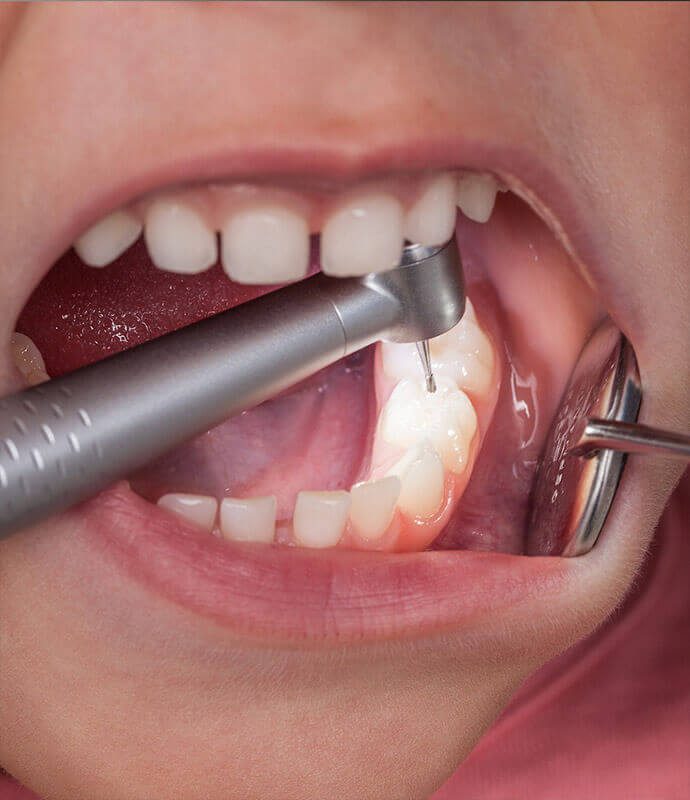 ¿QUÉ ES UN EMPASTE DENTAL? Clinica
