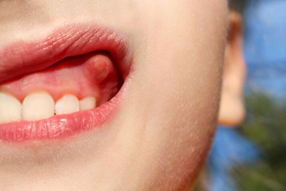 ¿Qué-es-y-como-se-trata-un-flemón-dental (1)