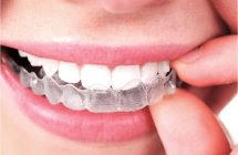 alineadores ivisalign