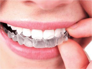 alineadores-invisalign alineadores ivisalign