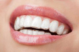 invisalign-invisible ortodoncia invisible