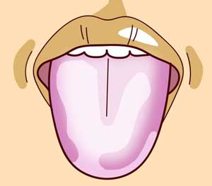 lengua enferma