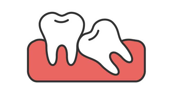dientes torcidos