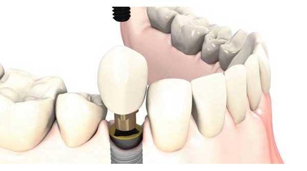 protesis dientes